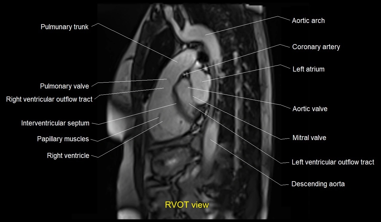 RVOT anatomy.webp
